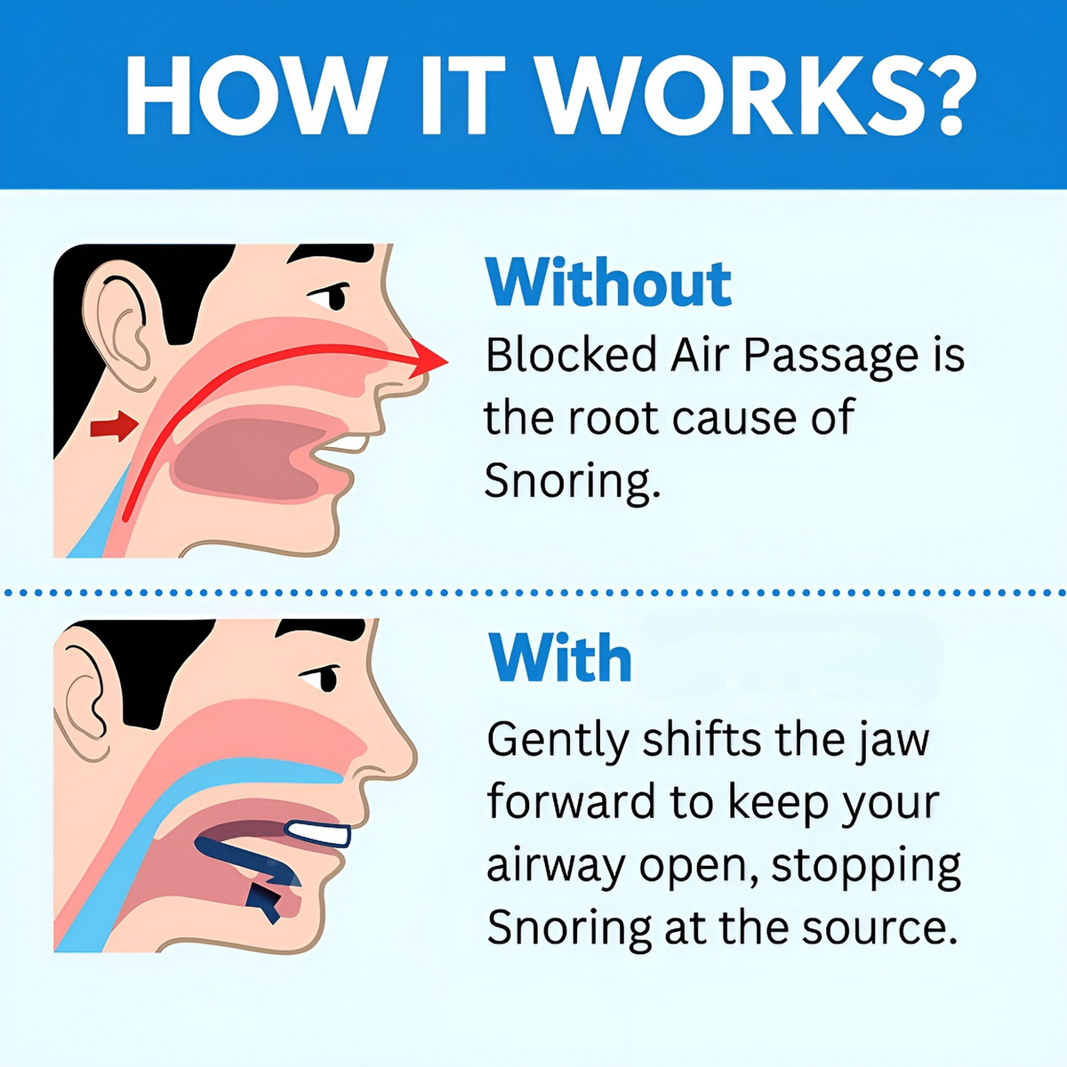 Hushly® Anti Snoring Mouthpiece